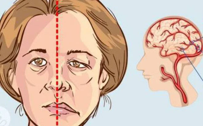 CÁC DẤU HIỆU NHẬN BIẾT ĐỘT QUỴ?